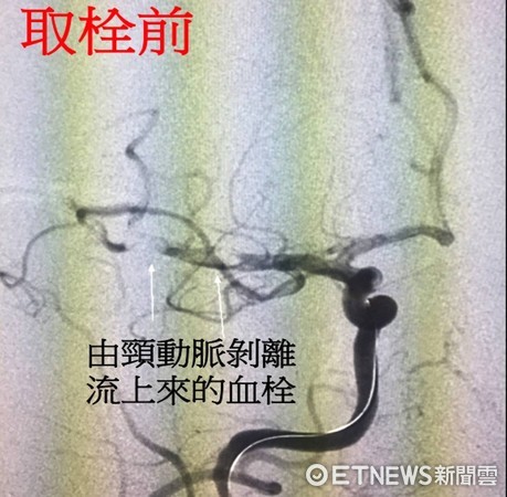 剧烈咳嗽致颈动脉剥离 台湾30岁男中风偏瘫(图) 剧烈咳嗽致颈动脉剥离 台湾30岁男中风偏瘫(图)