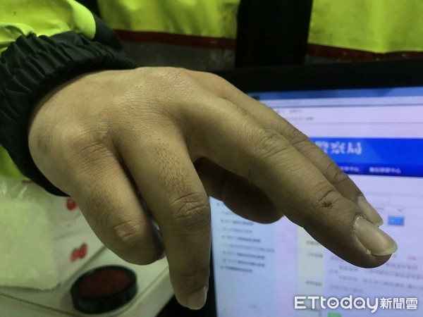 警察压制过程手部不慎擦挫伤。 警察压制过程手部不慎擦挫伤。