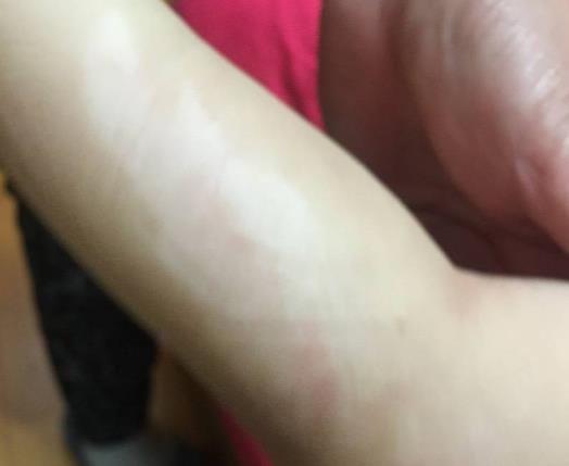 小学生遭导师拿热水壶烫醒 小学生遭导师拿热水壶烫醒