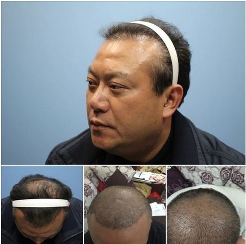 台民意代表为解决秃头植发秀照片求网友“放过”