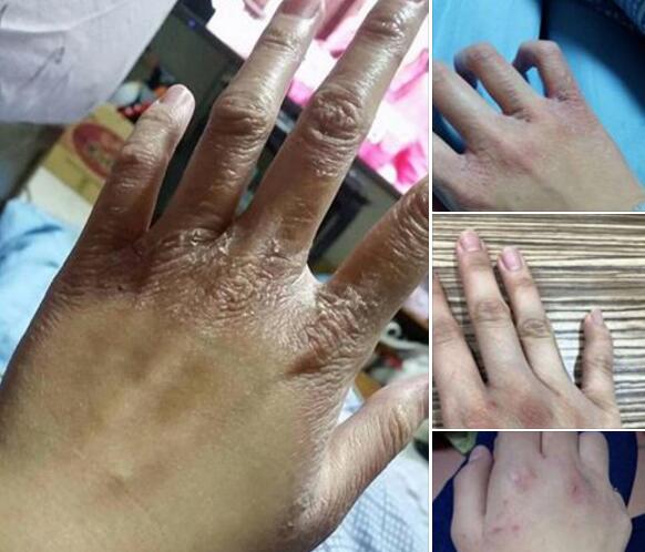 洗头妹妹手烂照片。(图片来源:台湾联合新闻网) 洗头妹妹手烂照片。(图片来源:台湾联合新闻网)