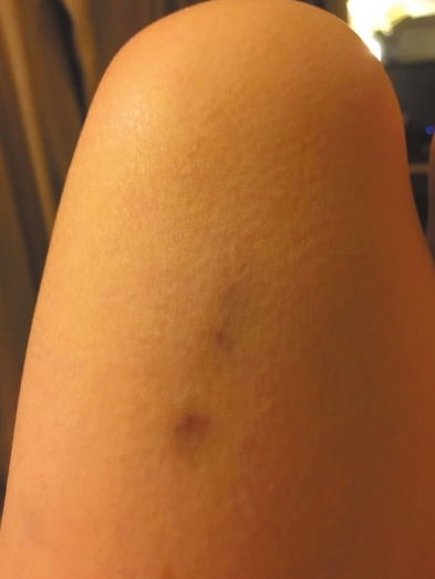 杨女士提供的照片显示,因反抗李某非礼造成其腿部淤青。京华时报记者韩林君摄