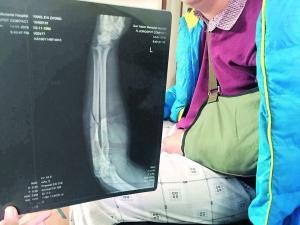 专车司机拒绝超载被乘客打成骨折 专车司机拒绝超载被乘客打成骨折