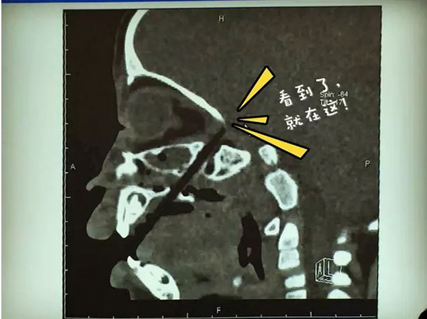 �������ѵ�����Ϊ��¶��ǻ����Ŀ��ӹ�����Ҫȫ����������������΢���ƶ��ʹ��ڷ��ա����ң�һ��ȡ�����Ӻ��л�Գ�Ѫ�����п�������Σ������������漰­�ڳ�Ѫ������Ҫ������­��������ʹ���ӳɹ�ȡ����Ҳ���и�Ⱦ�ķ��գ���Ϊ���ӱ��������ɾ����п��ܻᵼ��������ϵͳ��Ⱦ������ŧ��Ѫ֢��