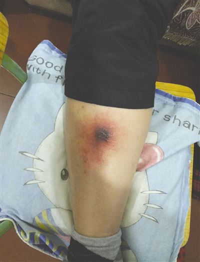 罗先生被虫咬了之后,腿部开始溃烂