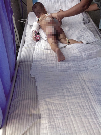 1岁男童掉进滚烫菜汤中 重度烫伤或影响发育 1岁男童掉进滚烫菜汤中 重度烫伤或影响发育