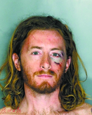 汤姆斯被打后面部缝了9针。