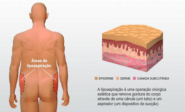 罗纳尔多为减肥抽脂?