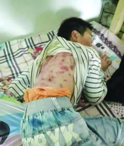 浑身伤痕的男孩（宁国网友供图）