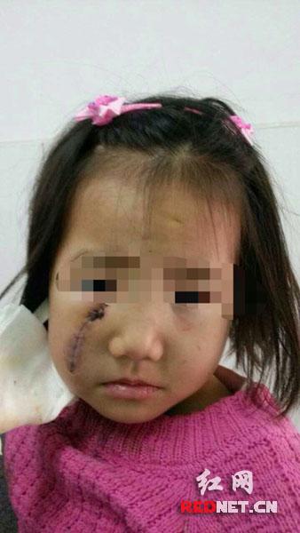 邻居打架砸碎啤酒瓶 4岁女童串门被飞溅碎片毁容