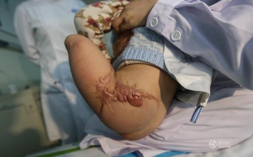 男童两岁时遇车祸双腿截肢 病房跳最炫"小苹果"