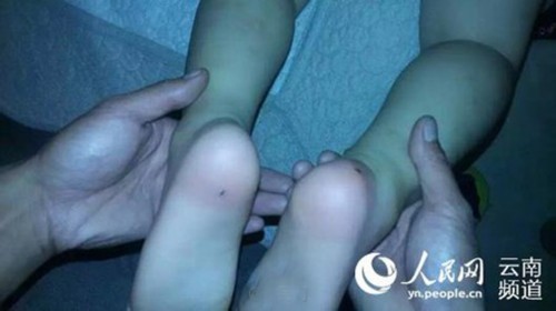4岁男童从幼儿园回来发现脚底被扎进2根牙签