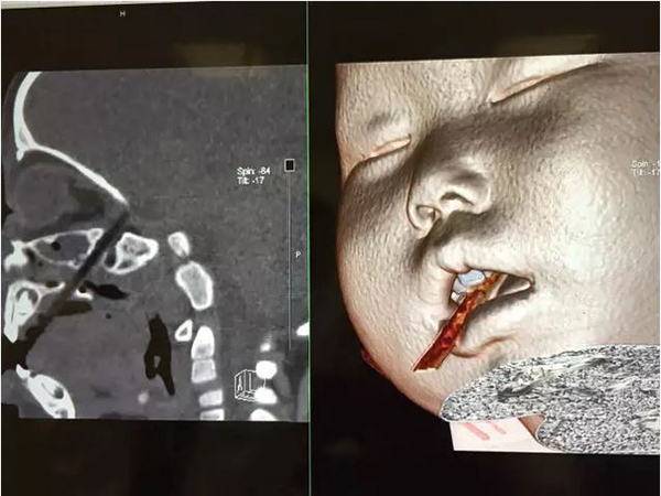 宝宝用筷子从嘴插进脑 医院3天收治2例:不能硬拔