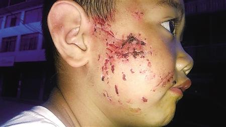 留守儿童独自在家被狗咬烂脸 生日愿望让人泪奔