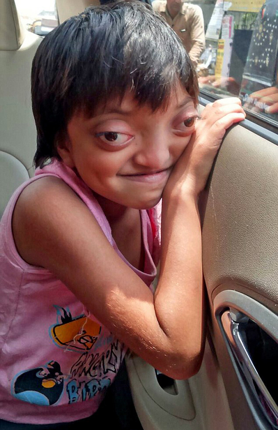 印度女孩患罕见病长"青蛙眼"被称外星人