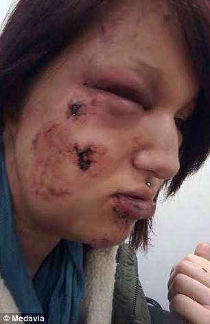 兽性大发!嫉妒男友狂咬女友21口被判刑