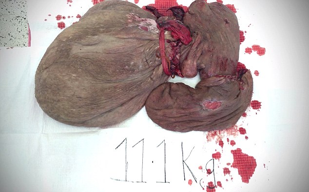 尼泊尔男子切除相伴47年面部肿瘤终解脱