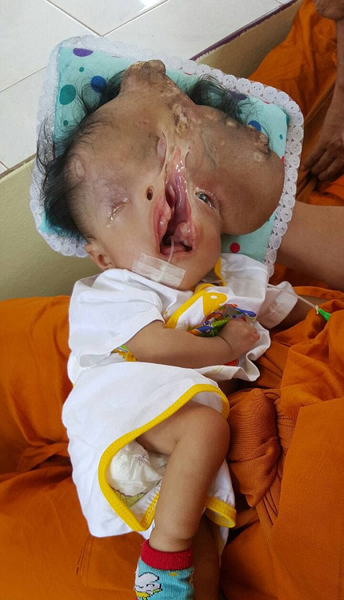 可怜泰重度残疾女婴先天失明颅骨缺损
