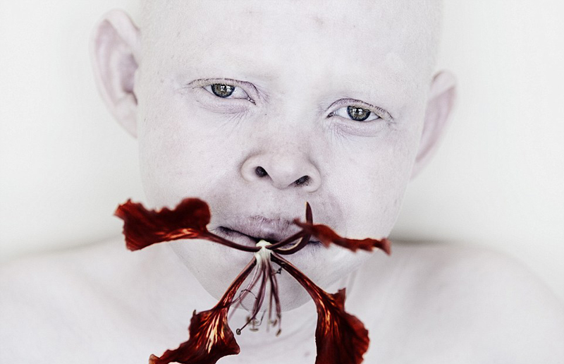 女摄影师拍非洲白化病患呼吁破除迷信