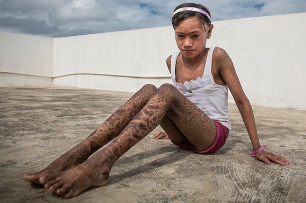 印度13岁少女全身如蛇皮 被当妖怪